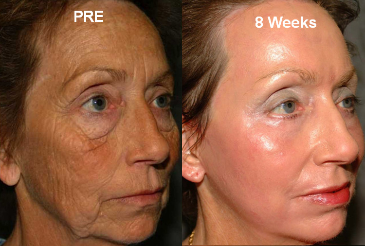 Pictures Of Laser Skin Resurfacing 31