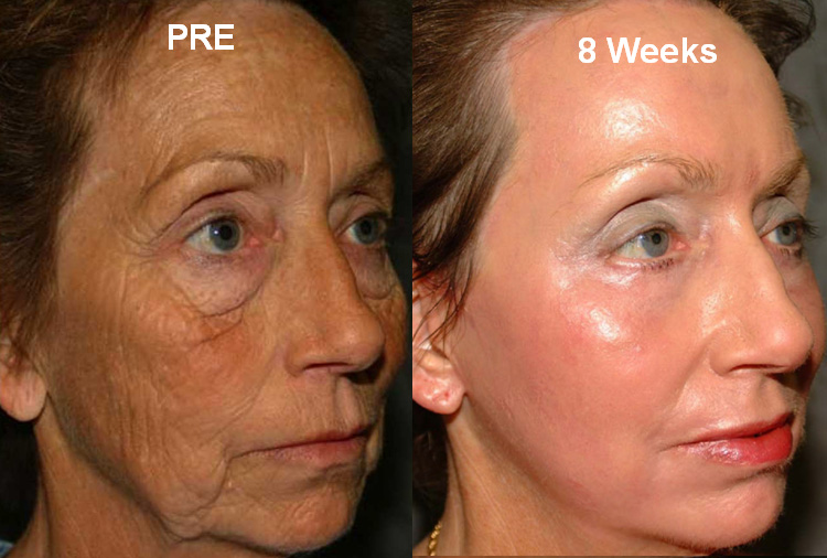 Facial Resurfacing Cost 99