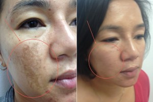 Melasma before and after