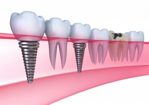 dental-implants-illustration