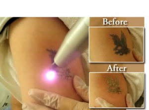 tattoo removal procedure in sydney
