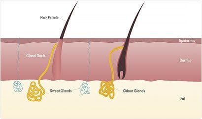 Excessive Sweating - Sydney Cosmetic Specialists